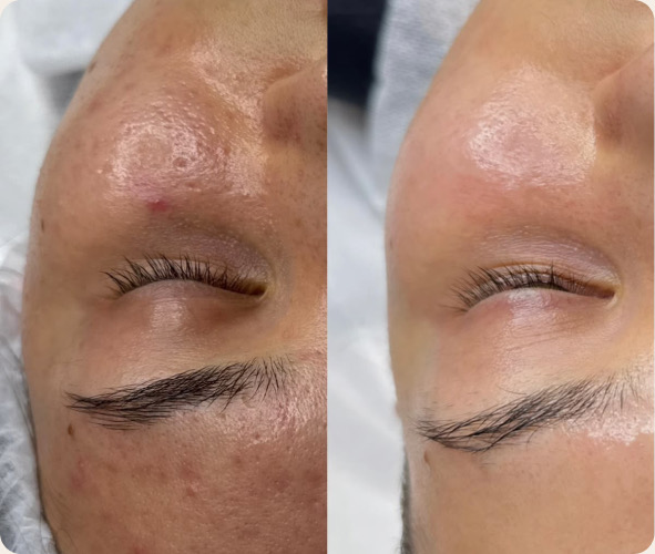 Avant et après soin du visage
